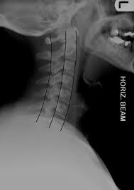 It's commonly done after someone has been in an automobile or other accident. The Cervical Spine