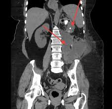 Image result for Perinephric Abscess