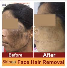 If you are susceptible to ingrown hairs that aggravate your skin and cause hyperpigmentation (suuuper. Laser Hair Removal à¤…à¤¨à¤š à¤¹ à¤¬ à¤² à¤• à¤¹à¤Ÿ à¤¨ à¤• à¤à¤• à¤¸ à¤µ à¤§ à¤œà¤¨à¤• à¤¤à¤° à¤• à¤¹ Laser Hair Removal Face Hair Removal Face Hair