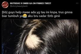 Dan yang paling sedih sekali is age limit semakin menurun dari sehari ke sehari. Muncul Pola Kebotakan Di Kepala Apa Penyebab Dan Bagaimana Cara Mengatasinya Halaman All Kompas Com