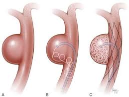 La que está afectada pierde el paralelismo de sus paredes y se dilata. Aneurisma Cerebral Alerta E Cuidados Imediatos Revista Interativa