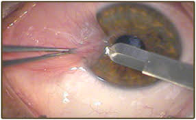 Kondisi ini umumnya terjadi pada lansia, dan bisa terjadi pada salah satu. Selaput Luar Pterygium Kristal