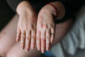 Image result for Atopic Dermatitis