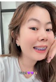 Light Violet Braces Color