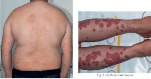 Image result for koebner phenomenon psoriasis