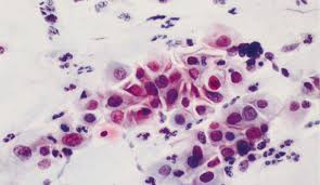 Secondary Prevention Of Cervical Cancer