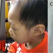 PDF) Diagnosis delay a family of Galloway-Mowat Syndrome caused by a  classical splicing mutation of Lage3
