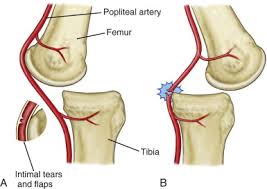 This causes tear or strain in the ligament. Vascular Problems Of The Knee Musculoskeletal Key