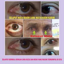 Selalunya, mata kuning pada seseorang menunjukkan kehadiran kegagalan dalam hati. Ainun Beauty Bebas Selaput Bukit Payong Tanda Awal Selaput Mata Mata Kuning Mata Selalu Merah Mata Terasa Kering Pedih Dan Gatal Rasa Berpasir Punca Selaput Mata Pulak