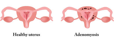 Both diseases can cause pain, sanjay agarwal, md, director for the center for endometriosis research and treatment at the university of california, san. Adenomyosis Treatment Symptoms Usa Fibroid Centers