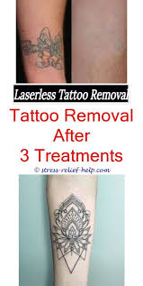 Small Tattoo Removal How Much Is Tattoo Removal Cream At Walmart Tattoo Removal Faq New Laser Tattoo Rem Tattoo Removal Cost Tattoo Removal Cream Tattoo Kits