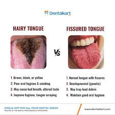 Image result for Fissured tongue
