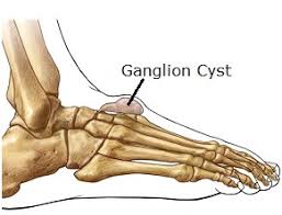 Poorly fitting shoes can worsen and, in some cases, cause foot problems. Pain On Top Of Foot Causes Symptoms Treatment
