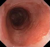 Image result for esophagus