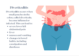 Image result for Diverticulitis