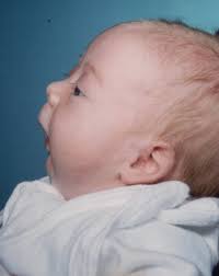 PIERRE ROBIN SYNDROME Pierre Robin...