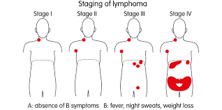 Maybe you would like to learn more about one of these? Childhood Hodgkin Lymphoma Disease Stages And Prognosis Acco