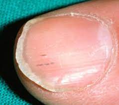Can you spots the signs? Essex Beautician Spots Client S Nail Stripe As Skin Cancer Daily Mail Online