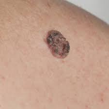 Melanoma skin cancer often starts as an abnormal mole anywhere on the skin. Emerging Noninvasive Treatments Of Nonmelanoma Skin Cancers Mdedge Dermatology