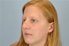 Rhinoplasty Before and After Photos by Paul Vanek, MD, FACS; Concord, OH