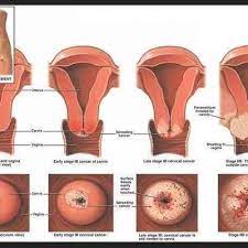 Kebanyakan kanser rahim adalah kanser endometrium. Tanda Tanda Kanser Rahim Kanser Ovari Punca Simptom Dan Rawatan The Diagnosa Rahim Govdesinin Kanseri Altinda Endometrial Kanser Uterusun Mukoza Zari Ima Edilmektedir Oreo In Mon Worlds