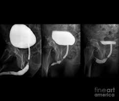 Image result for Voiding Cystourethrogram