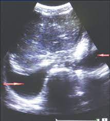 Multiplane ultrasound approach to quantify pleural effusion at the bedside. Ultrasound Image Showing Bilateral Pleural Effusion Download Scientific Diagram
