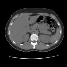 Number of new cases in 2020, both sexes, all ages. Elevated Liver Enzymes Cancer Therapy Advisor