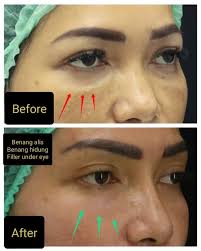 Contoh under eye filler pengisian 90% seperti pd penjelasan  @tanya.dr.stiven., ., #drstiveneli #aesthetic #klinikkecantikan #botox  #filler #threadlift #education