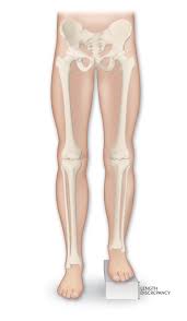 Image result for Functional Leg Length Discrepancy