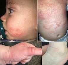 Atopic Dermatitis Presentation and Diagnosis