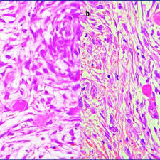 Exposure to asbestos is one of the known causes for mesothelioma formation. Pdf Sclerosing Peritoneal Mesothelioma In A Dog Histopathological Histochemical And Immunohistochemical Investigations
