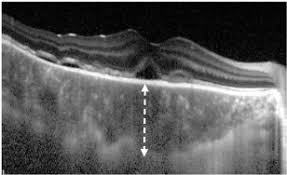 To determine classification criteria for acute posterior multifocal placoid pigment epitheliopathy (apmppe). Acute Posterior Multifocal Placoid Pigment Epitheliopathy Sharing Characteristic Oct Findings Of Vogt Koyanagi Harada Disease