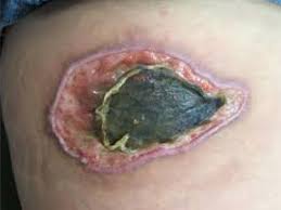 Eschars usually develop a few days to a week following the bite of an infected tick or mite. Eschar Vs Scab Chronic Wound Management Types Of Wound Tissue
