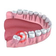 Relief for blocked hair follicles. Wisdom Tooth Removal Recovery Philadelphia Pa Dr Kellyn Hodges