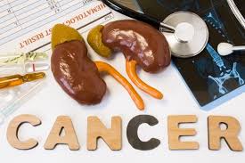 Studypages A Study Of The Experimental Antibody Pf 04518600 With Or Without Axitinib For Metastatic Kidney Cancer