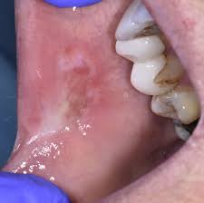 Image result for Labial mucosa