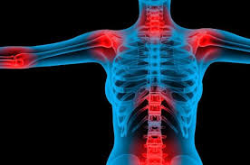 Fibromialgia y dolor de cabeza. Fibromialgia Physiotherapy Balnea Terme Della Salvarola