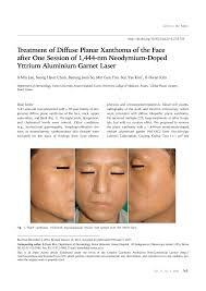 A xanthoma is a deposit of fat on the skin, commonly around the eyes, joints, hands or feet. Pdf Treatment Of Diffuse Planar Xanthoma Of The Face After One Session Of 1 444 Nm Neodymium Doped Yttrium Aluminium Garnet Laser