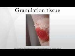 Check spelling or type a new query. Granulation Tissue Youtube