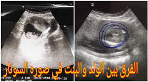 Maybe you would like to learn more about one of these? Ù…Ù‚Ø§Ø±Ù†Ø© Ø¨Ø§Ù„Ø³ÙˆÙ†Ø§Ø± Ø¨ÙŠÙ† Ø§Ù„Ø¬Ù†ÙŠÙ† Ø§Ù„Ø°ÙƒØ± ÙˆØ§Ù„Ø§Ù†Ø«ÙŠ Ø§Ù„ÙØ±Ù‚ Ø¨ÙŠÙ† Ø³ÙˆÙ†Ø§Ø± Ø§Ù„ÙˆÙ„Ø¯ ÙˆØ§Ù„Ø¨Ù†Øª Youtube