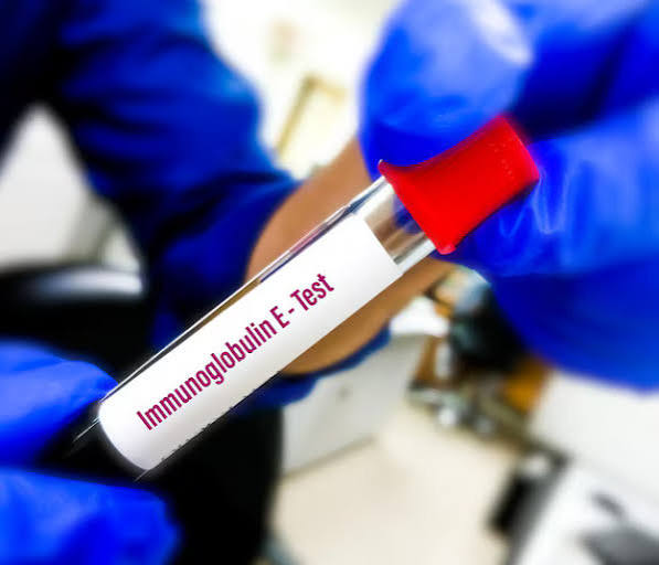 IgE (Immunoglobulin E) Blood Test - ARC Medical