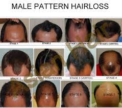 Historically the least likely to go bald, east asians' changing lifestyles have caused a sharp increase in hair loss. Androgenic Alopecia Best Treatment Options Dr Julieta Arambulo