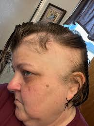 Genuine question. How does Princess Kate still have her hair if she's  having chemotherapy. I have always believed that our hair falls out under  chemo treatment.