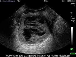 Image result for corpus luteum sonography)