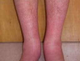Erythromelalgia Dermnet Nz Treatment Neuropathy Peripheral Neuropathy