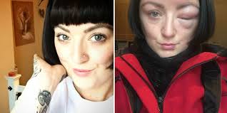 Instead, they show up the second, third or fourth time around, says dr. Woman S Face Swells Due To Horrifying Allergic Reaction To Hair Dye Hair Dye Allergy