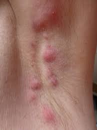 Pimples on buttocks will often appear as small raised bumps. Hidradenitis Suppurativa Medlineplus Genetics