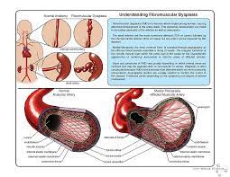 Fibromuscular Dysplasia Patient Education Patient Education Stroke Awareness Shoulder Muscle Anatomy