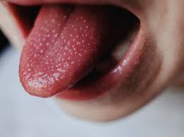 Image result for brown tongue symptoms